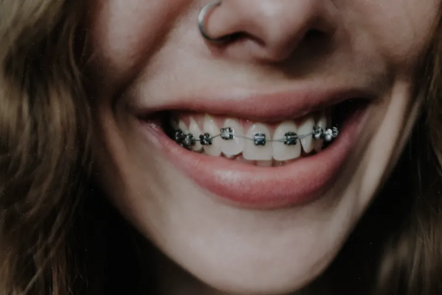 Cuidado Dental: Los Beneficios de la Ortodoncia