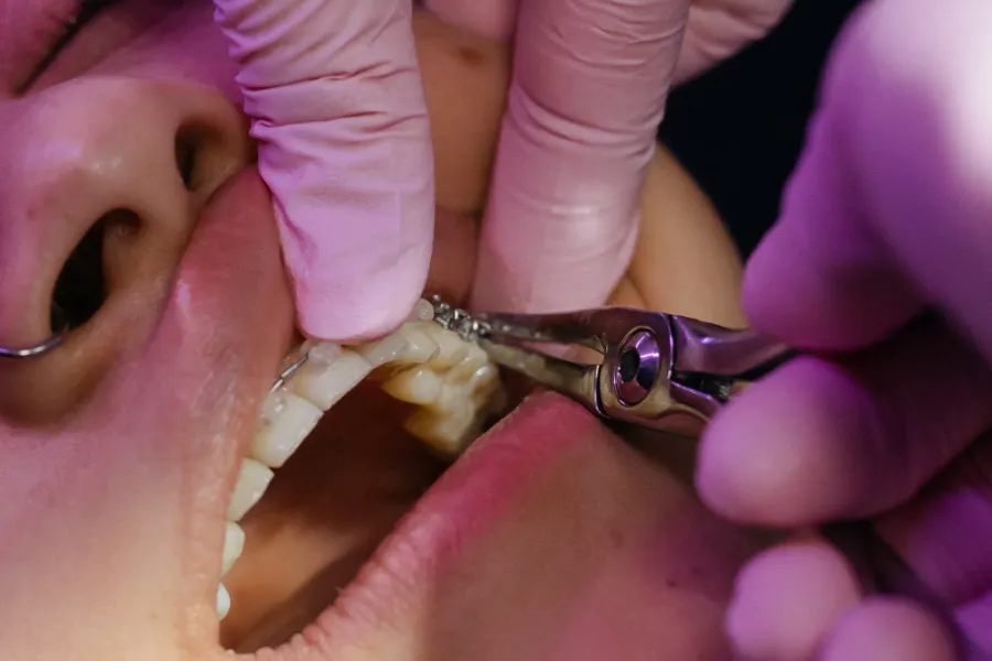 Cuide Su Salud: Utilice Ortodoncia
