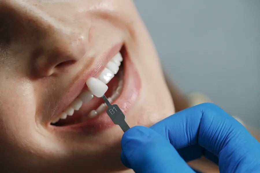 Beneficios de una sonrisa bonita ¿Cómo la implantología dental puede mejorar su calidad de vida