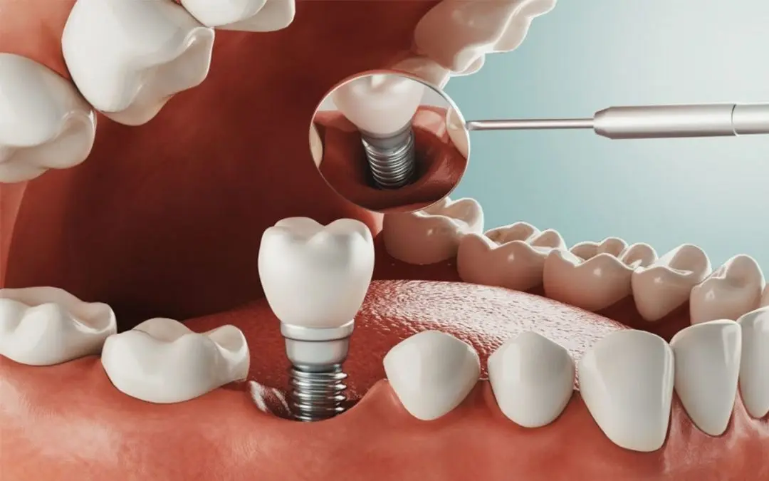 Encuentra el tratamiento dentista adecuado con la implantología dental