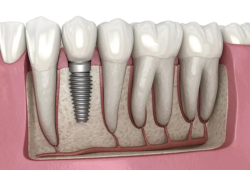 Precio para Implantes Dentales en Valencia