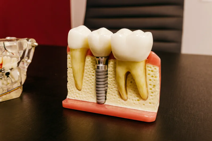 Todo lo que debes saber sobre el mantenimiento de la implantología dental