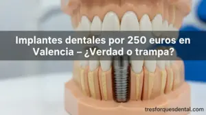implantes-dentales-por-250-euros
