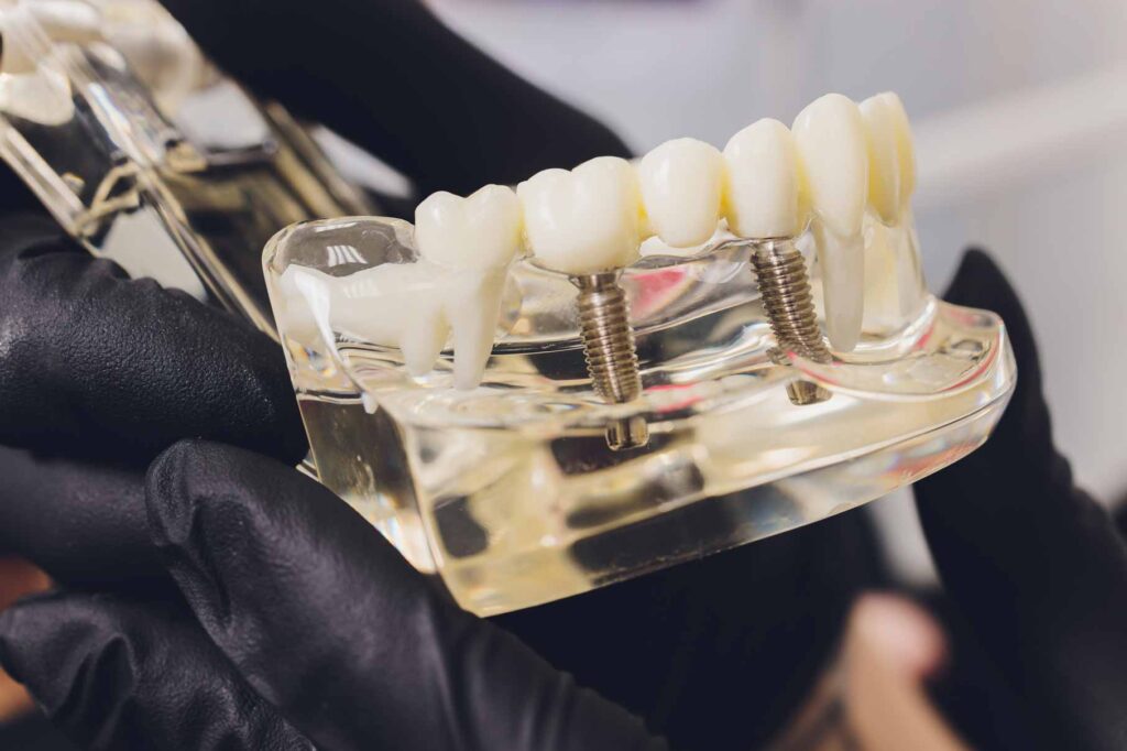 implantes dentales realizados en tres forques dental