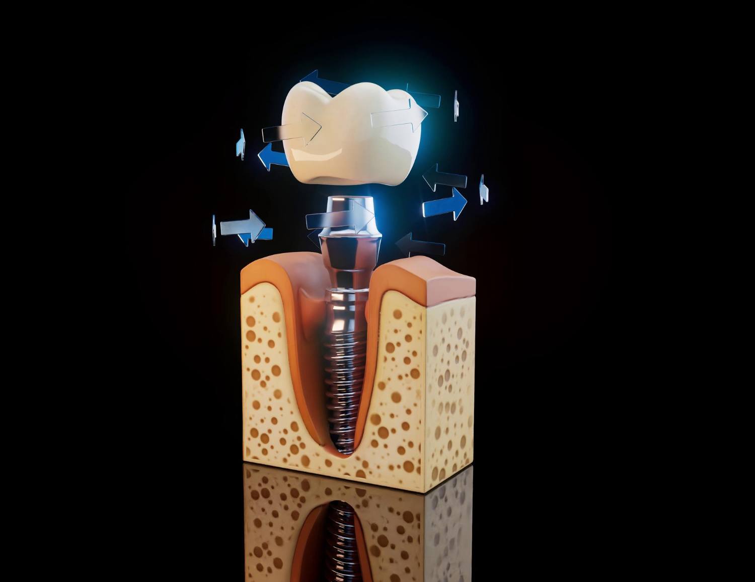 implante dental unitario en tres forques dental