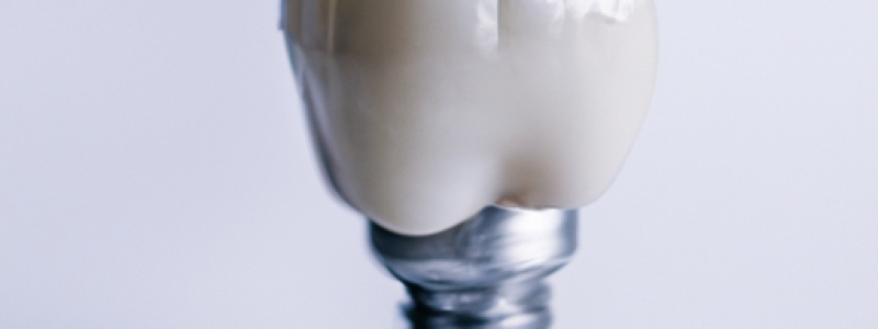 La implantología dental: su papel crucial en la prevención de enfermedades bucales