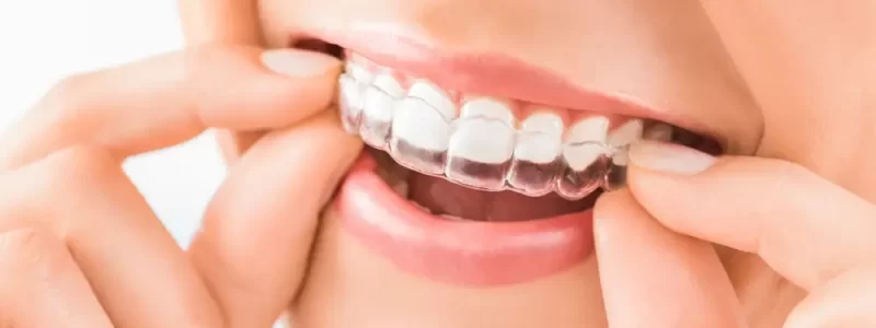 Invisalign Invisalign