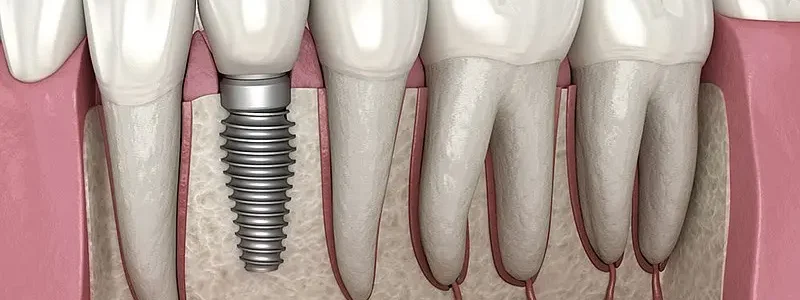 Precio para Implantes Dentales en Valencia Precio para Implantes Dentales en Valencia