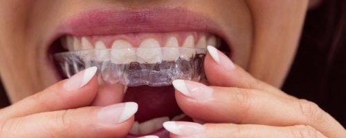 clínica dental en valencia clínica dental en valencia