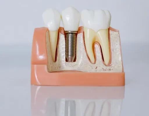 implantes dentales – tres forques dental implantes dentales - tres forques dental