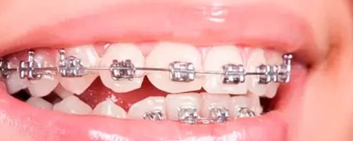 ortodoncia dental en valencia ortodoncia dental en valencia