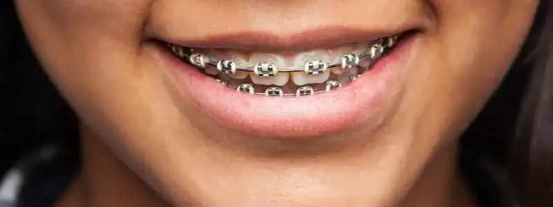 vida-con-brackets-como-cuidar-tus-dientes-con-ortodoncia vida-con-brackets-como-cuidar-tus-dientes-con-ortodoncia